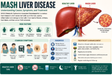 what is mash liver disease​