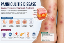 panniculitis disease​